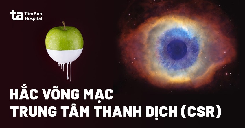 Hắc võng mạc trung tâm thanh dịch (CSR): Nguyên nhân và triệu chứng
