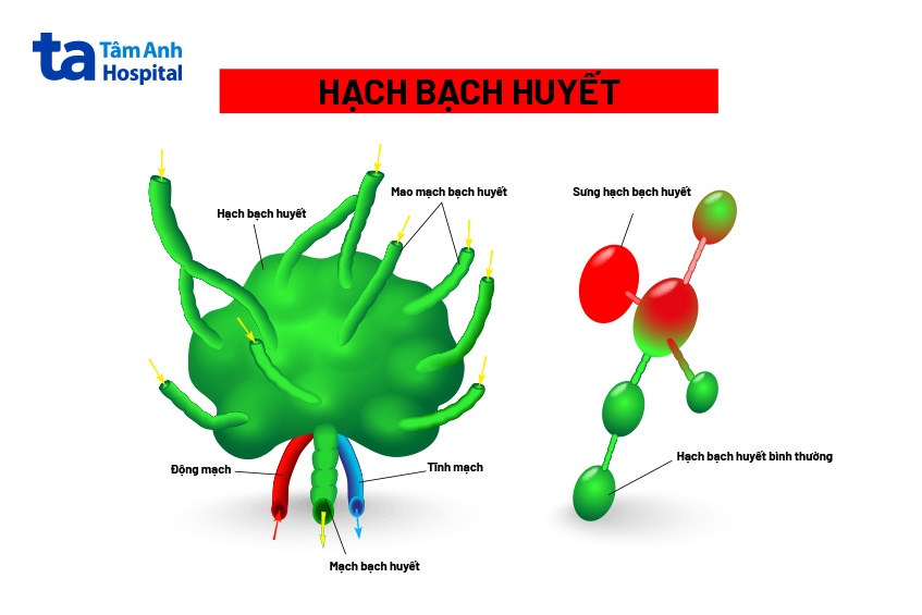 Hạch bạch huyết bình thường và hạch bạch huyết bị sưng