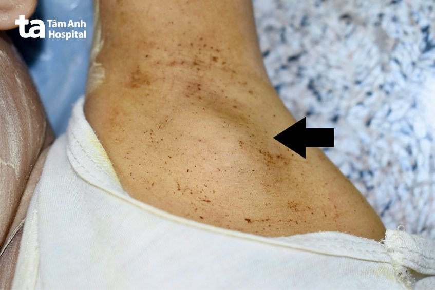 Hạch nách sưng to