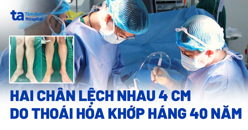 Hai chân lệch nhau 4 cm do thoái hóa khớp háng 40 năm