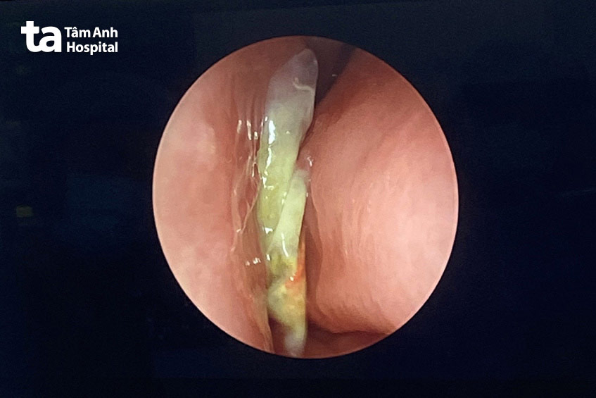 Hình ảnh dị vật trong mũi bé