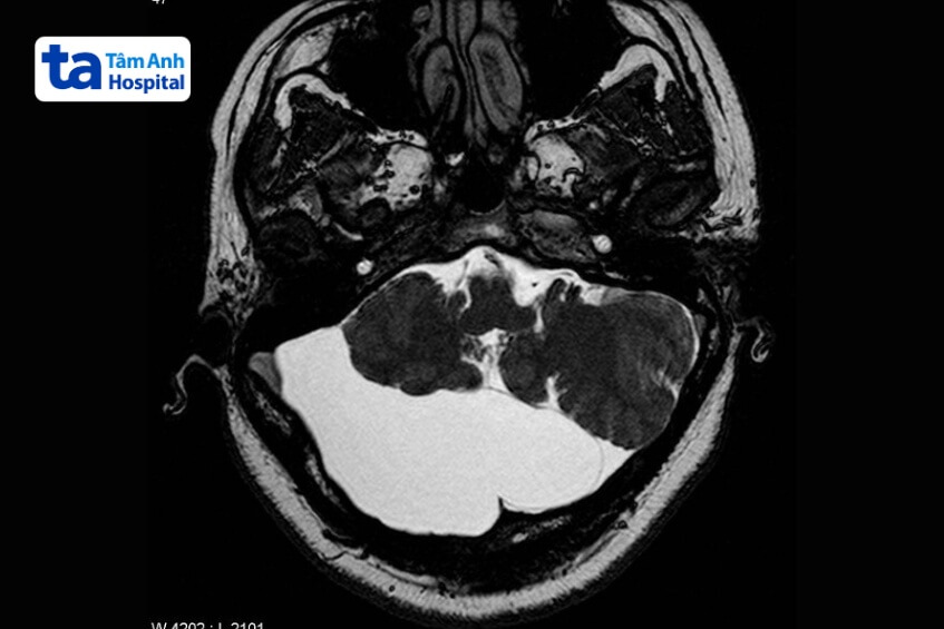 hình ảnh mri nang màng nhện nguy hiểm 