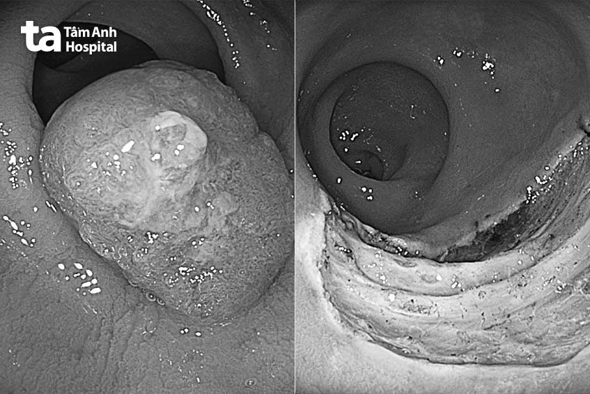 Hình ảnh nội soi trước và sau khi cắt u bằng esd