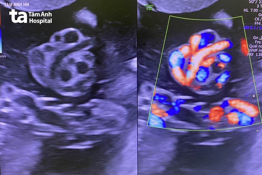 Hình ảnh siêu âm dây rốn thắt nút