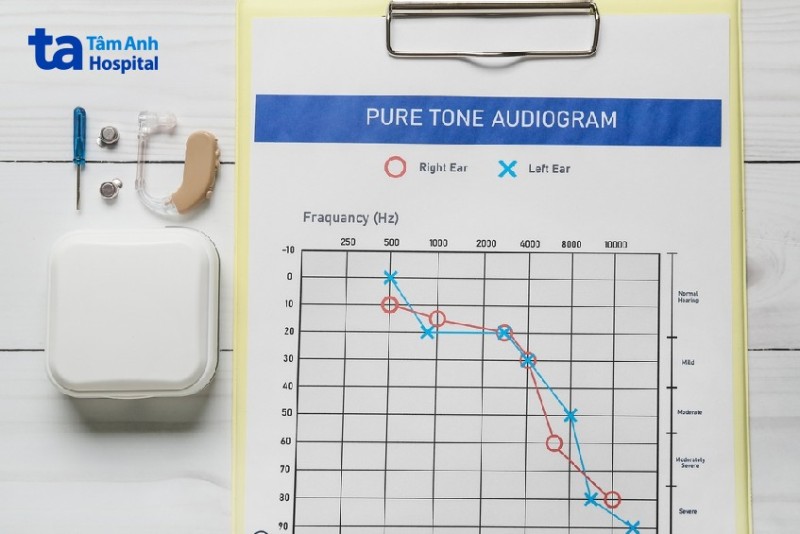 kết quả khám thính lực bình thường