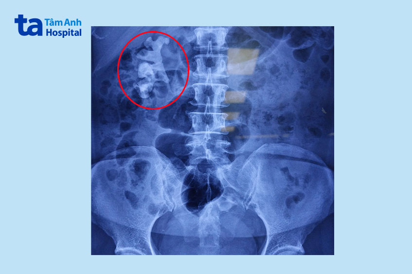 khối sỏi san hô trong thận phải