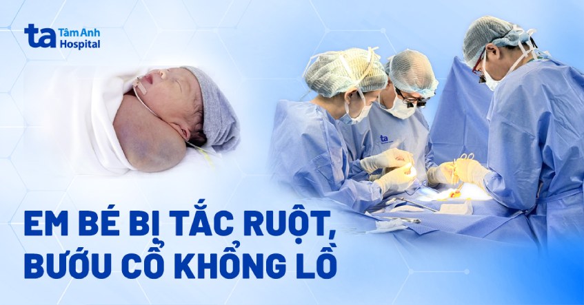 Khối u nặng gần 1/3 cơ thể bé trai sơ sinh