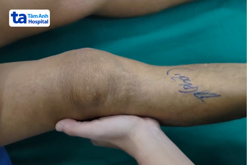 Khớp gối lỏng lẻo nghiêm trọng