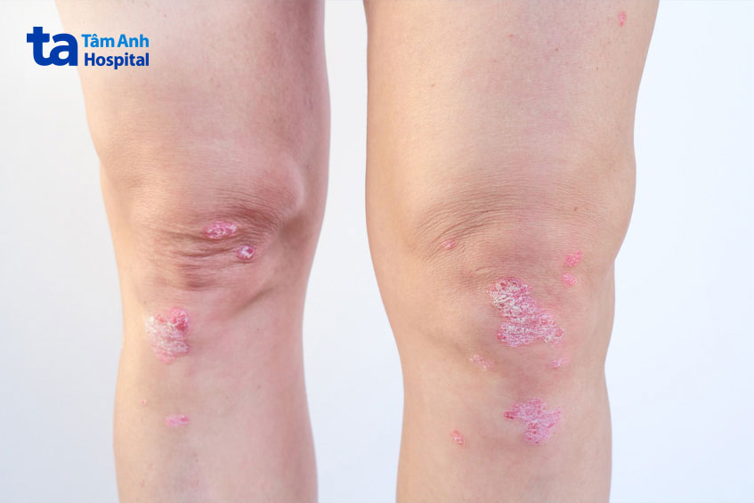 khớp gối tràn dịch do nhiều nguyên nhân khác nhau