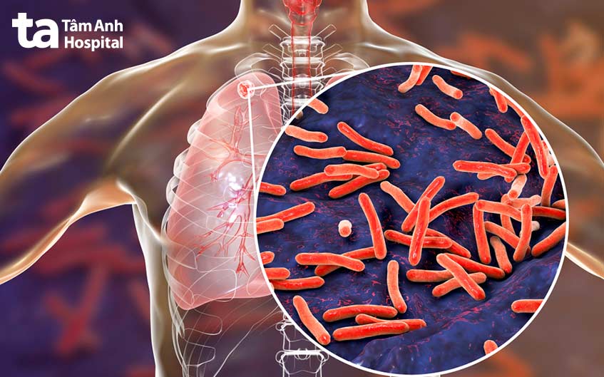 Lao phổi chiếm đến 85 phần trăm các trường hợp