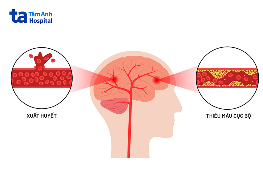 LDL Cholesterol tăng cao liên quan đến bệnh mạch máu não