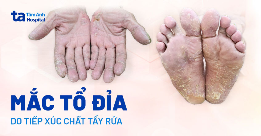 Mắc tổ đỉa do tiếp xúc chất tẩy rửa bằng tay không