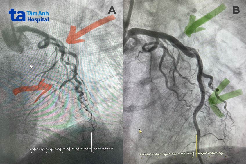 Hình ảnh mạch vành trái ngoằn ngoèo, tắc hẹp nhiều đoạn (hình A) và sau khi được đặt stent khơi thông (hình B)