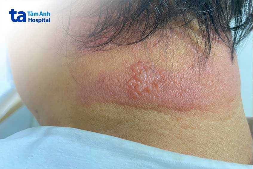 Màng đỏ và mụn nước, bọng nước