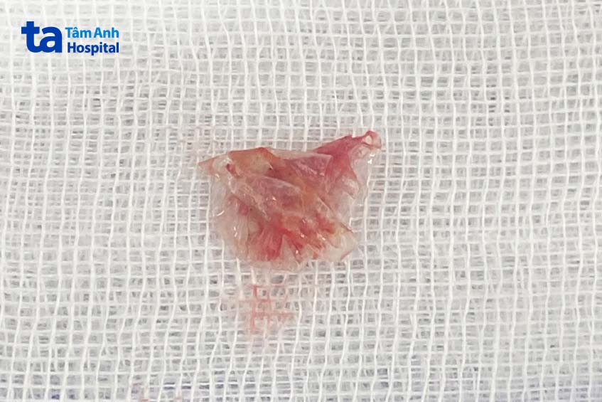 Mảnh ni lông được lấy ra từ mũi bé