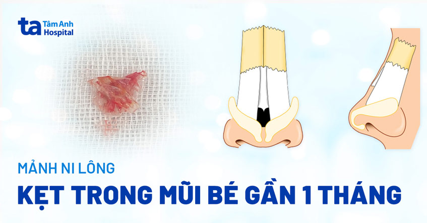 mảnh ni lông kẹt trong mũi gần 1 tháng