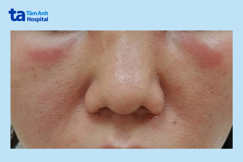 Mề đay gây sưng nề do dị ứng với hải sản