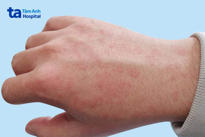 Mề đay trên da một bệnh nhân dị ứng cua