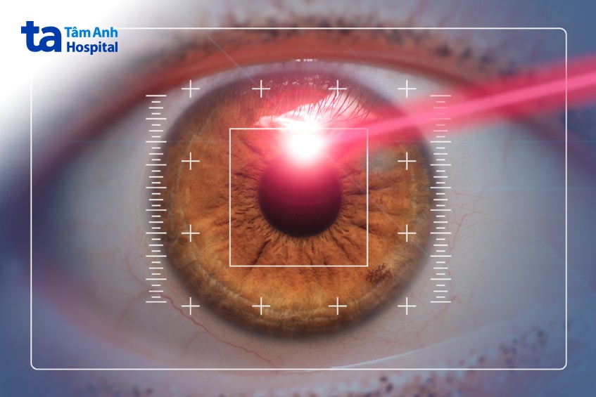 mổ đục thủy tinh thể bằng hệ thống femtosecond laser