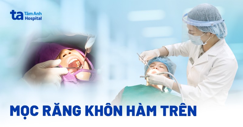 Mọc răng khôn hàm trên: Khi nào, triệu chứng và cách giảm nhẹ