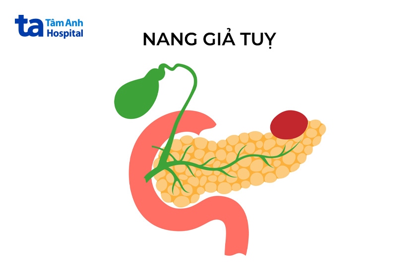nang giả tụy là gì