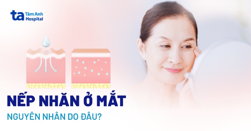 Nếp nhăn ở mắt: Nguyên nhân, dấu hiệu và biện pháp ngăn ngừa