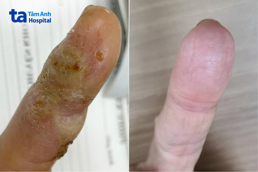 Ngón tay bà D trở về bình thường sau 1 tháng điều trị