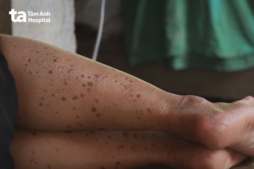 nguyên nhân chân bị đốm nâu