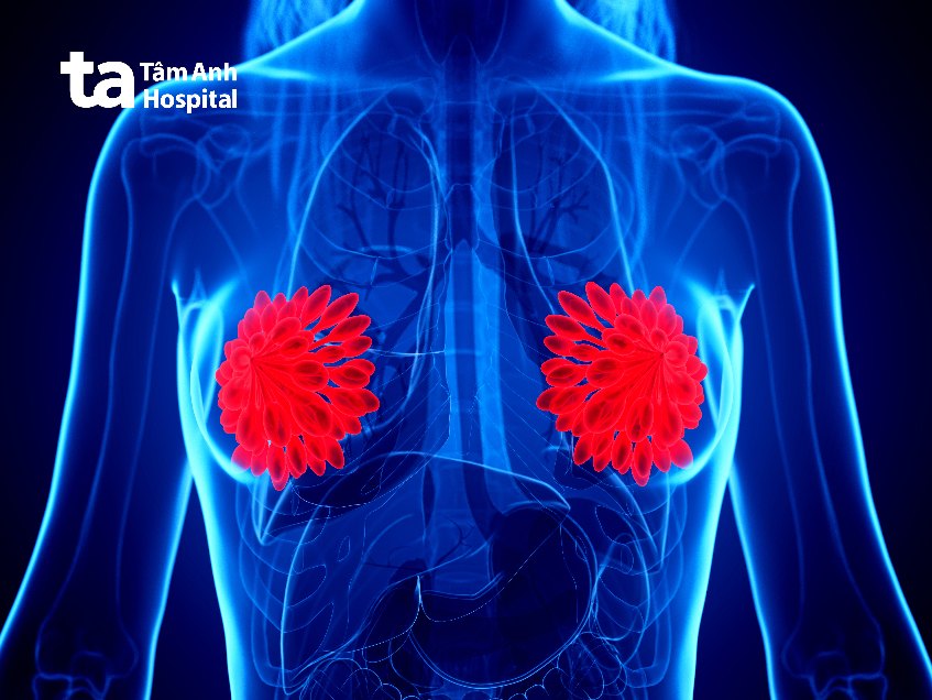 nguyên nhân gây đa nang tuyến vú