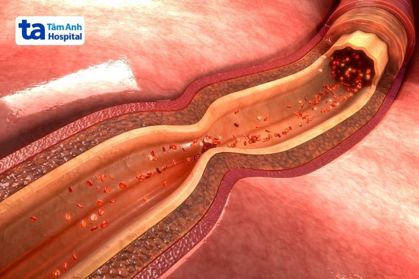Nguyên nhân nhồi máu cơ tim thường gặp do tắc nghẽn động mạch vành