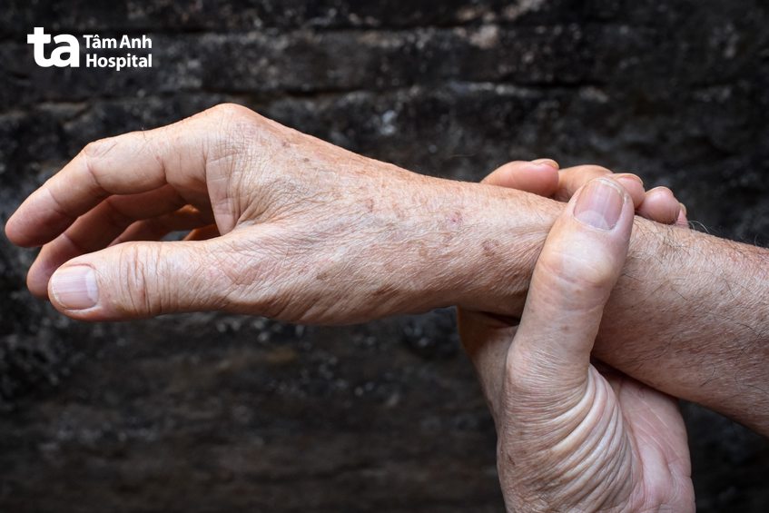 nguyên nhân tay bị nổi đốm nâu