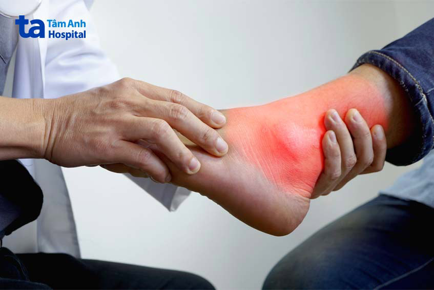 nhận biết các dấu hiệu tràn dịch cổ chân