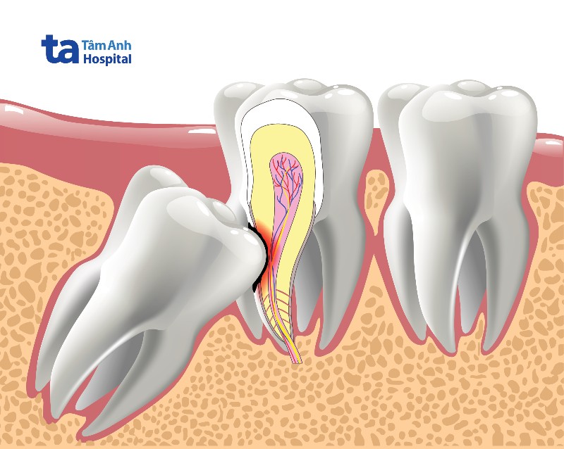 Không nhổ răng cùng hàm dưới có sao không?