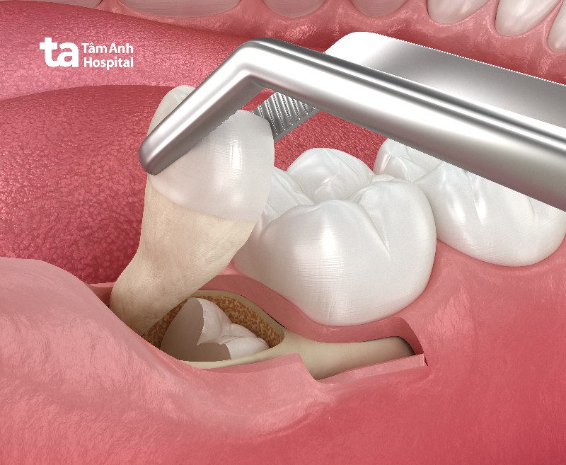 Nhổ răng khôn hàm dưới bằng phương pháp truyền thống