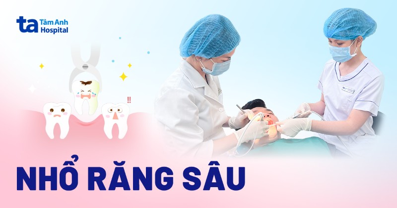 Nhổ răng sâu: Trường hợp cần nhổ, quy trình và lưu ý cần biết