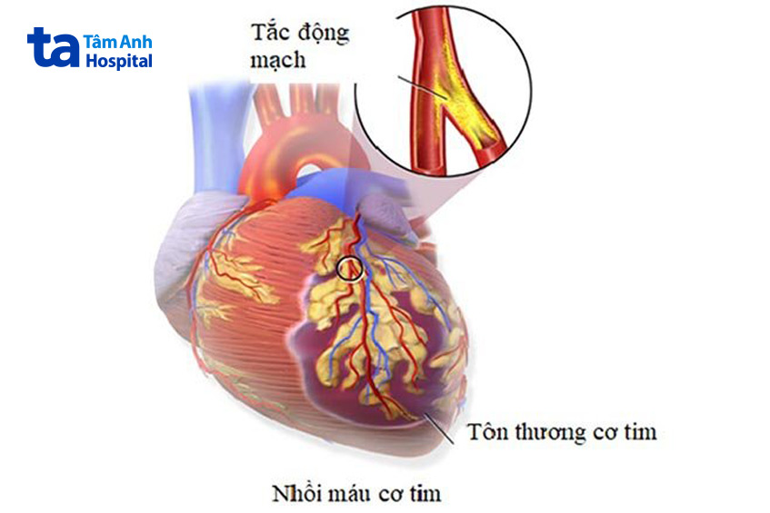 Nhồi máu cơ tim ở người trẻ gây ra nhiều biến chứng nguy hiểm