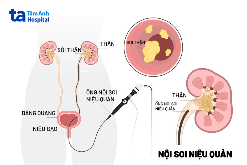 Nội soi tán sỏi bằng ống mềm