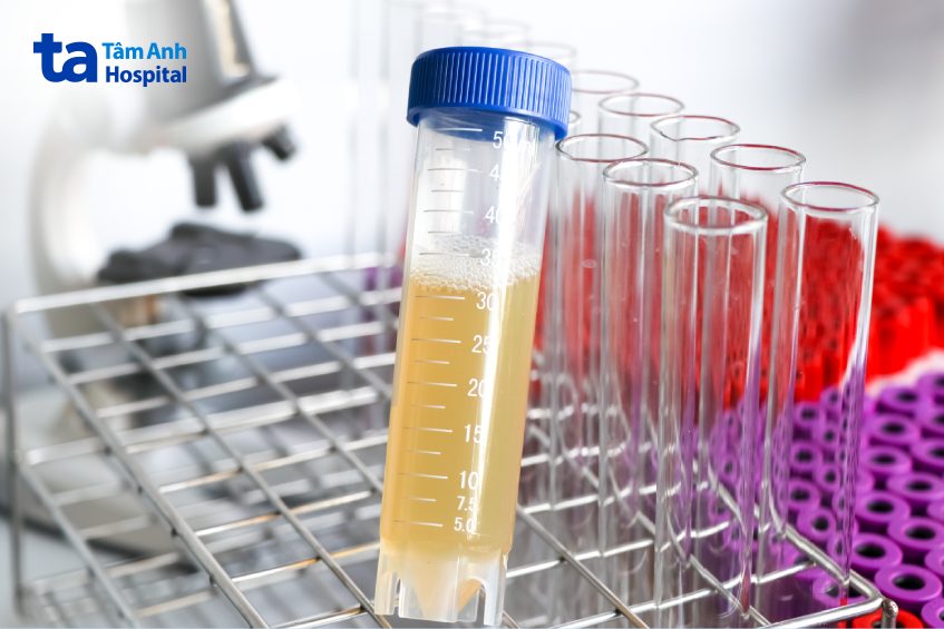 nước tiểu có bọt thường xuyên cảnh báo bệnh thận