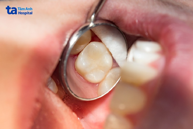 Phân loại răng hàm