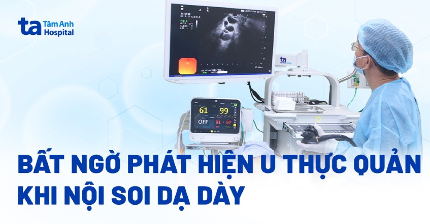 phát hiện u thực quản khi nội soi