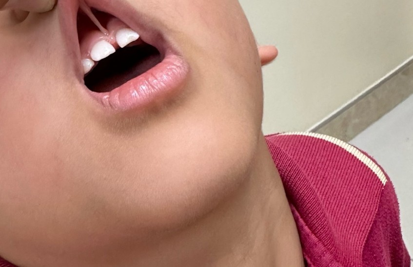 Thắng môi tồn tại 7 năm khiến bé Luân gặp nhiều biến chứng