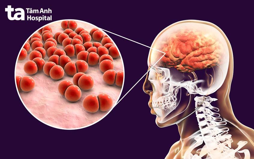 Phế cầu gây viêm màng não viêm phổi viêm tai giữa