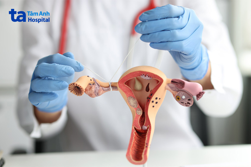 Phụ nữ cần điều trị triệt để dịch ứ vòi trứng trước khi làm IVF