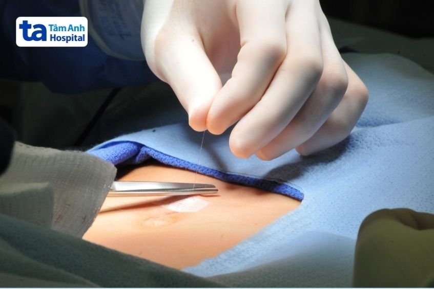 quy trình phẫu thuật thoát vị thành bụng