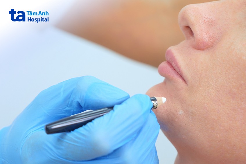 quy trình tiêm bap 5 điểm tại bvđk tâm anh