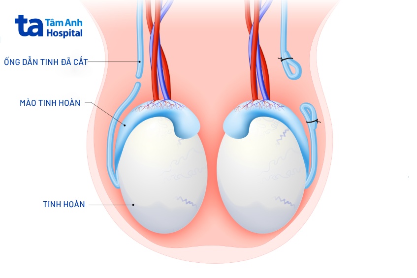 quy trình triệt sản nam