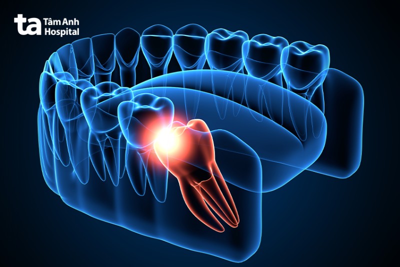 Các kiểu răng số 8 mọc lệch