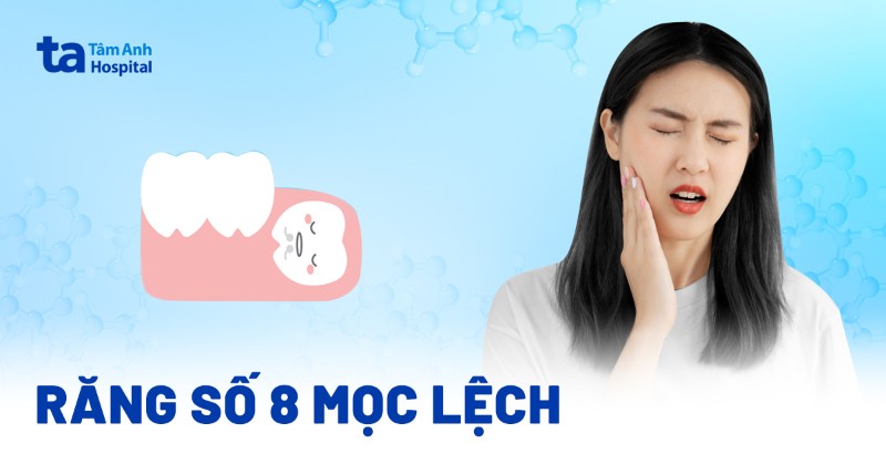 Răng số 8 mọc lệch: Dấu hiệu nhận biết, tác hại và cách xử lý