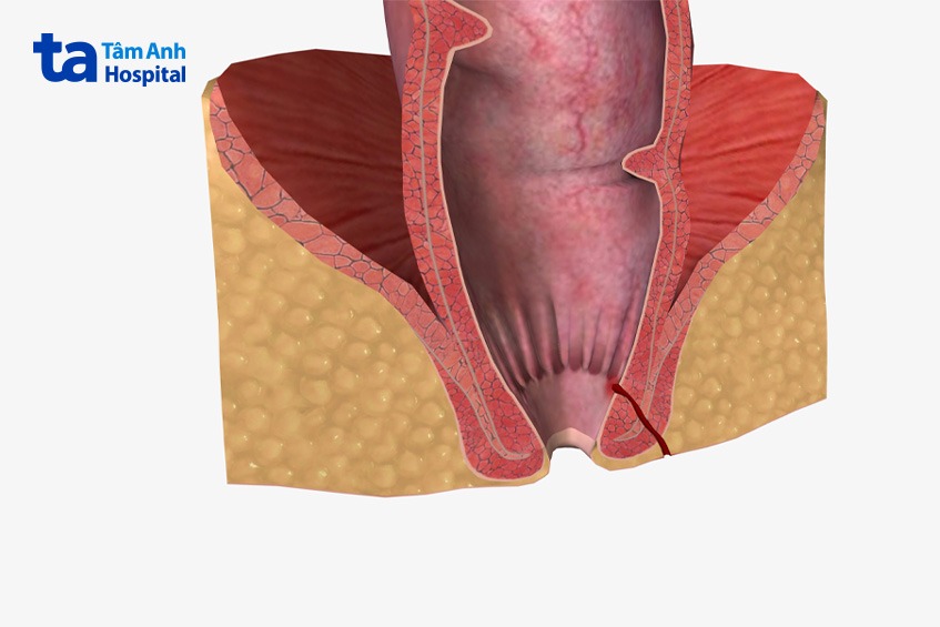bệnh rò hậu môn có nguy hiểm