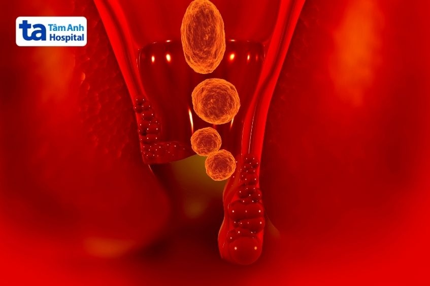rò hậu môn tái phát sau phẫu thuật